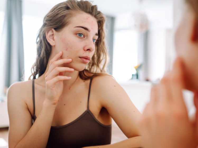 Acné: cómo prevenirlo, tratarlo y evitar que deje marcas