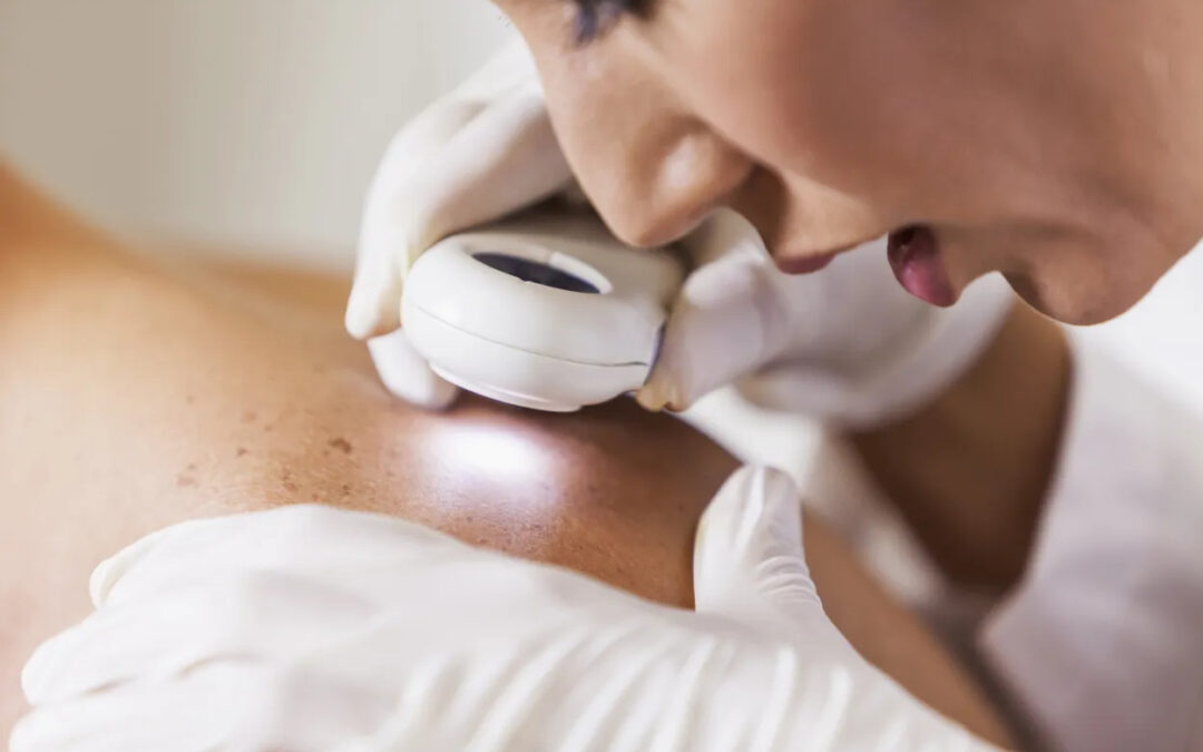 Cáncer de piel: qué hacer y cómo cuidarse tras el diagnóstico