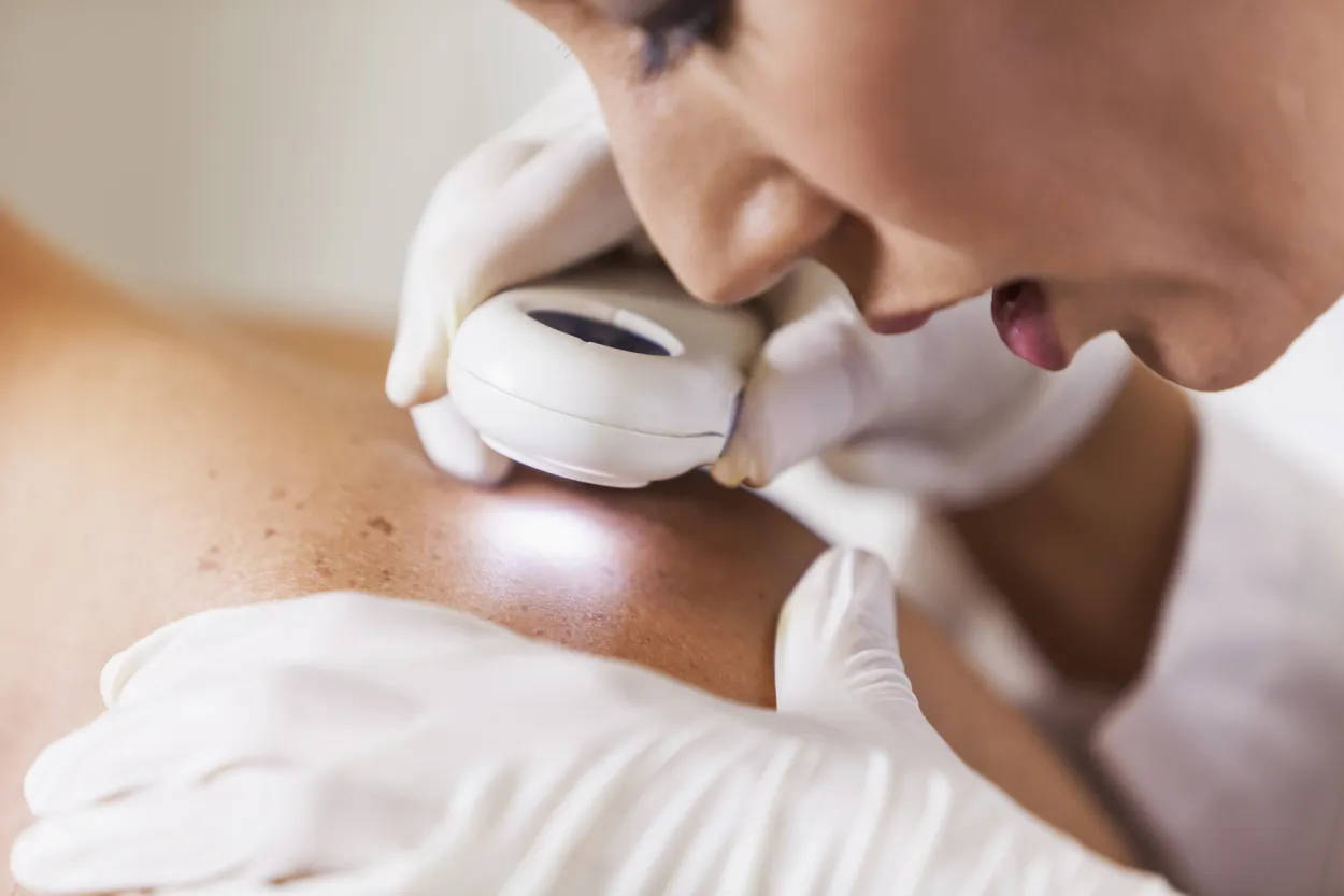 Paciente cuidando su piel tras diagnóstico de cáncer de piel