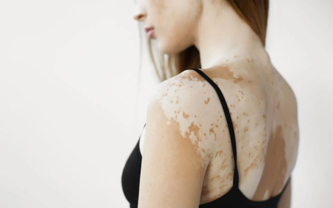 Qué es el Vitiligo y por qué sale: la mirada de una experta