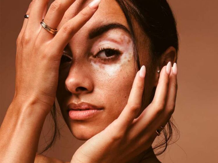 Vitiligo: qué es, a quién afecta y por qué deja marcas más allá de la piel