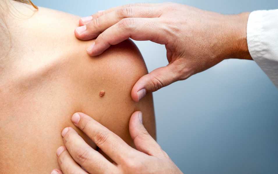 Control dermatológico para prevenir y diagnosticar cáncer de piel