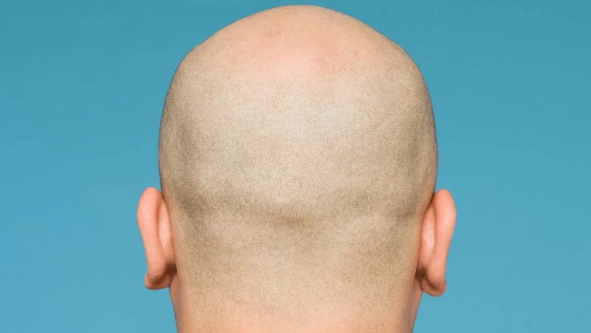 Persona recibiendo tratamiento capilar para frenar la alopecia