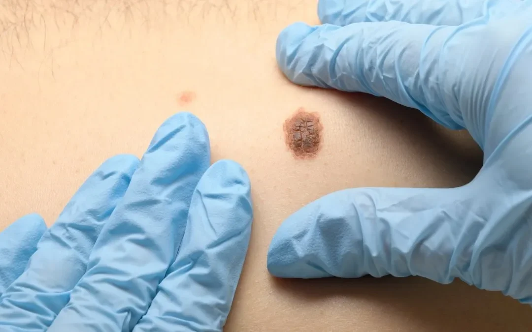 Día Mundial del Melanoma: Claves de una especialista en cáncer de piel