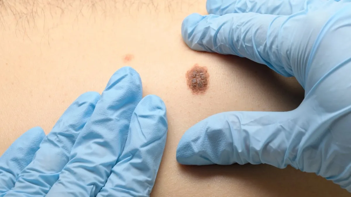 Dermatóloga realizando control de lunares para prevenir melanoma