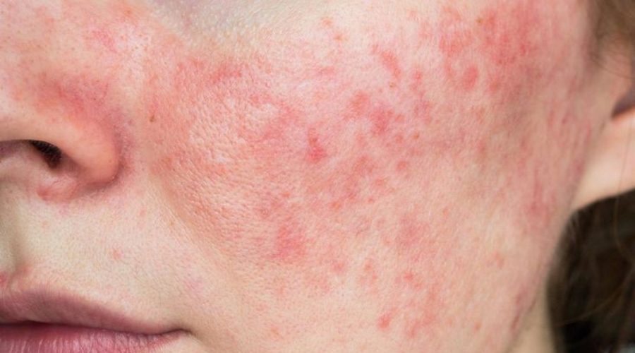Dermatitis atópica: cómo reconocer los brotes, evitar desencadenantes y cuidar la piel